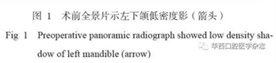 下颌骨腓骨移植联合牙种植术后的覆盖义齿修复1例