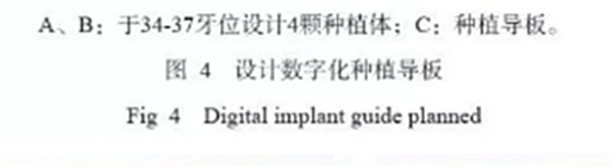 下颌骨腓骨移植联合牙种植术后的覆盖义齿修复1例