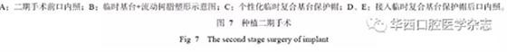 下颌骨腓骨移植联合牙种植术后的覆盖义齿修复1例