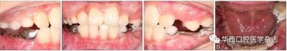 右下颌第一磨牙远中水平阻生1例