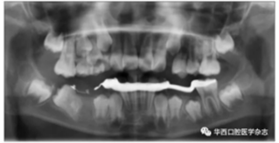 右下颌第一磨牙远中水平阻生1例