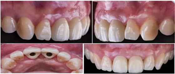 Asc全瓷角度基台一体冠进行种植前牙美学修复一例