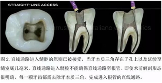 【病例分享】根管冠部预敞