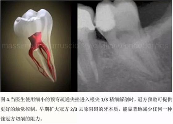 【病例分享】根管冠部预敞