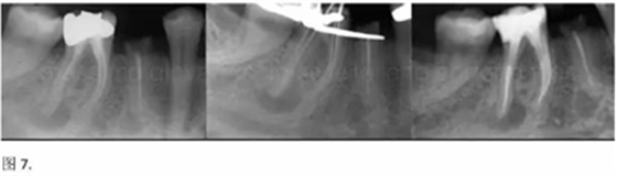 【病例分享】根管冠部预敞