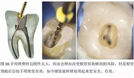 【病例分享】根管冠部预敞