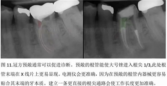 【病例分享】根管冠部预敞