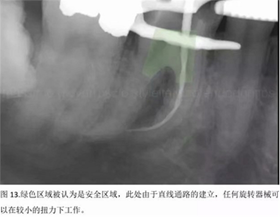 【病例分享】根管冠部预敞