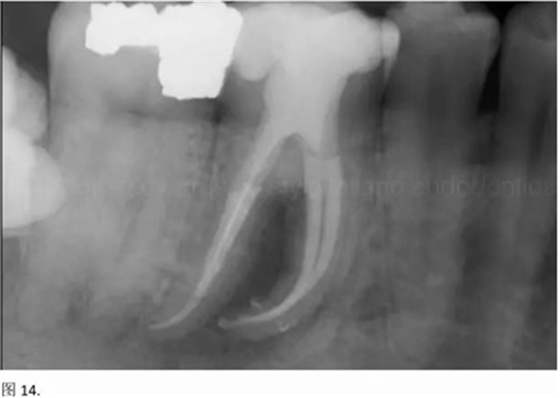 【病例分享】根管冠部预敞