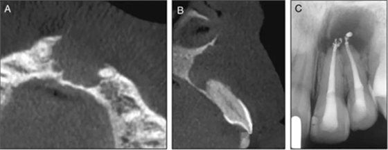 【病例分享】治疗后的根尖周炎与根尖外的独立感染