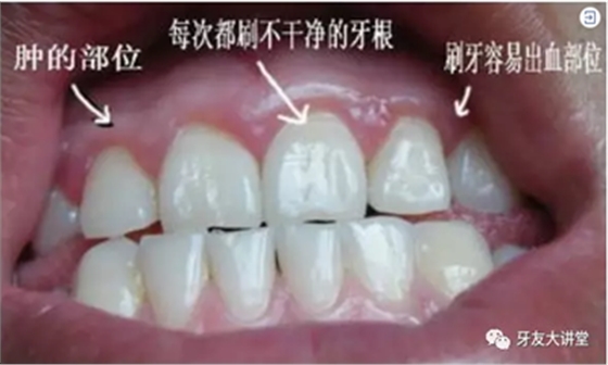 怎样预防牙龈萎缩