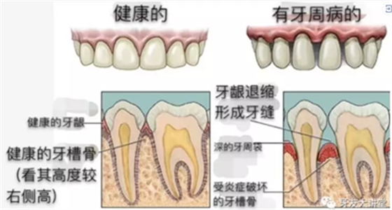 怎样预防牙龈萎缩