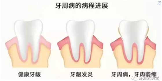 怎样预防牙龈萎缩