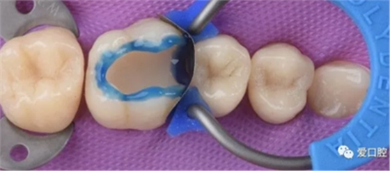 复合树脂直接粘接牙体修复技术临床常见问题及处理
