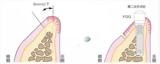 种植体周围角化龈的获得时期与方法