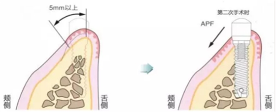 种植体周围角化龈的获得时期与方法