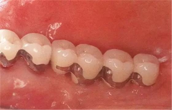 种植体周围角化龈的获得时期与方法