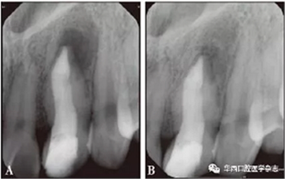 根尖屏障技术治疗Ⅱ型牙内陷引发慢性根尖周炎1例
