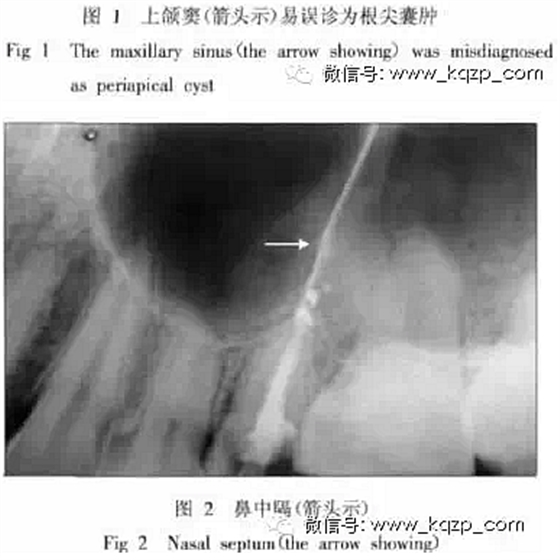 X线牙片在牙齿疑难病例诊断中的参考价值