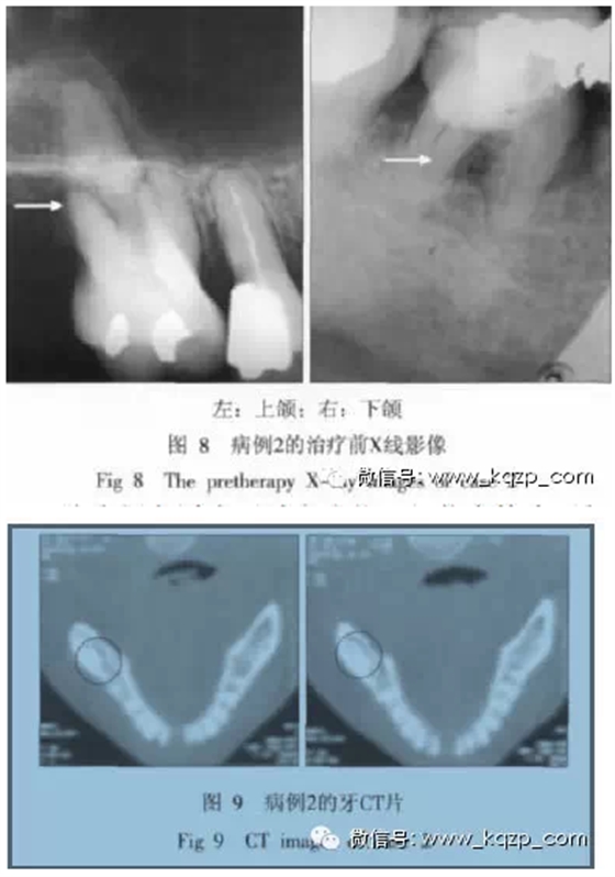 X线牙片在牙齿疑难病例诊断中的参考价值