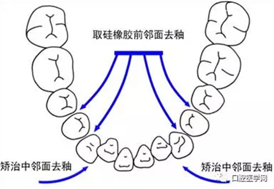 邻面去釉技术详解