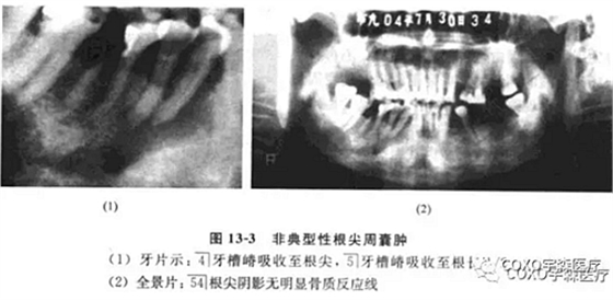 根尖周病的鉴别诊断