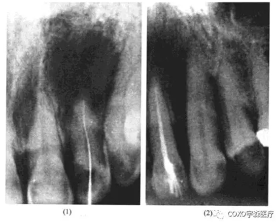 根尖周病的鉴别诊断