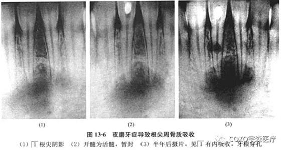 根尖周病与夜磨牙症