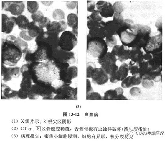 根尖周病的鉴别诊断