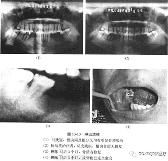 根尖周病与骨结核