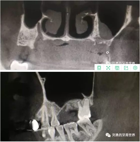 失败上颌窦种植患者的补救