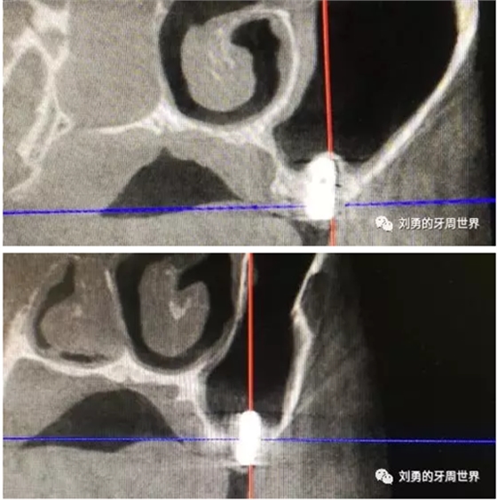 失败上颌窦种植患者的补救