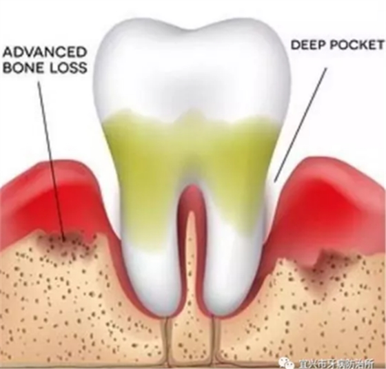 	牙周疾病，让妈妈的牙齿过早脱岗！