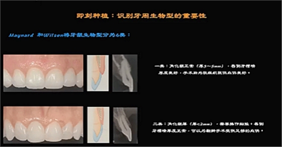 即刻种植的成功要素