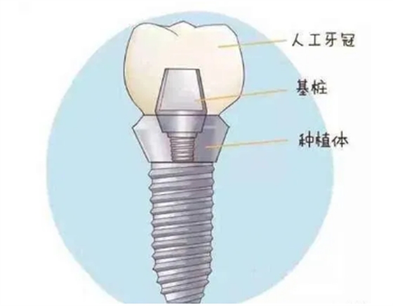 最详细的种植牙流程
