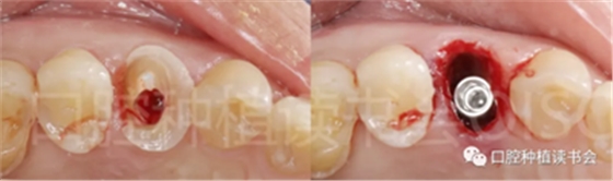 后牙区即刻种植临床指南