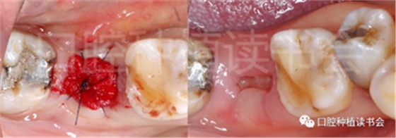 后牙区即刻种植临床指南