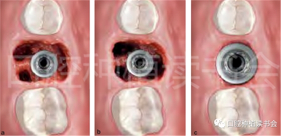 后牙区即刻种植临床指南