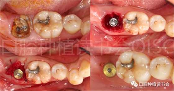 后牙区即刻种植临床指南