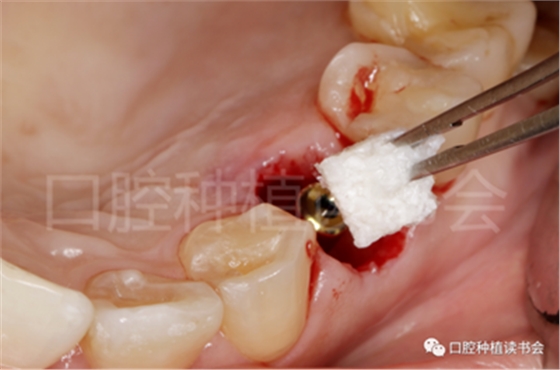 后牙区即刻种植临床指南