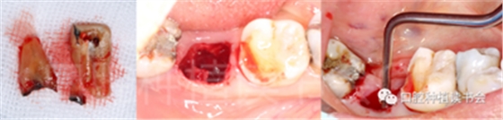 后牙区即刻种植临床指南