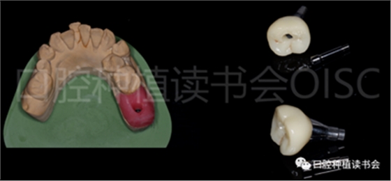 后牙区即刻种植临床指南