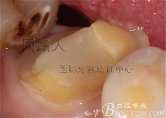 树脂嵌体制作的阶段性总结