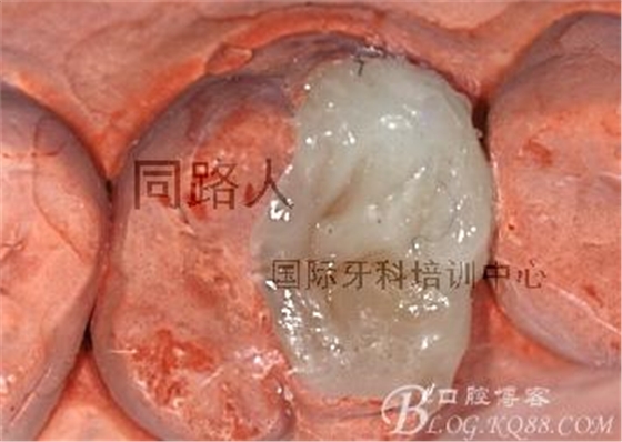 树脂嵌体制作的阶段性总结