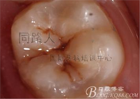 树脂嵌体制作的阶段性总结