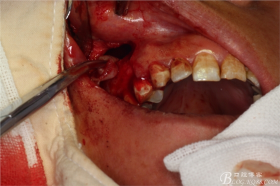 上颌磨牙区囊肿摘除+根尖切除术