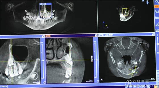 CBCT可以使拔牙更微创