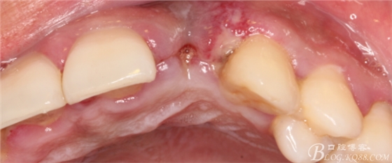 一例上前牙种植失败病例的补救（梁光强）