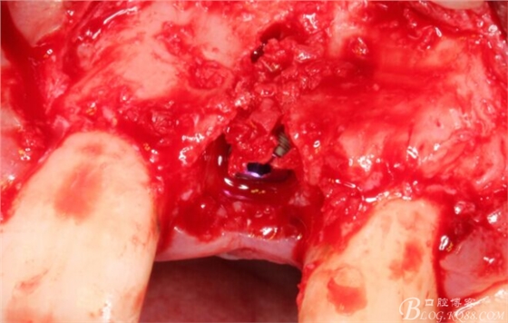 一例上前牙种植失败病例的补救（梁光强）
