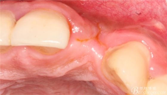 一例上前牙种植失败病例的补救（梁光强）